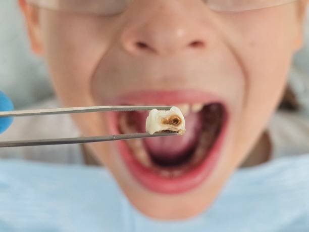 Best Broken or Cracked Tooth Emergency Dentist in Hinckley, IL